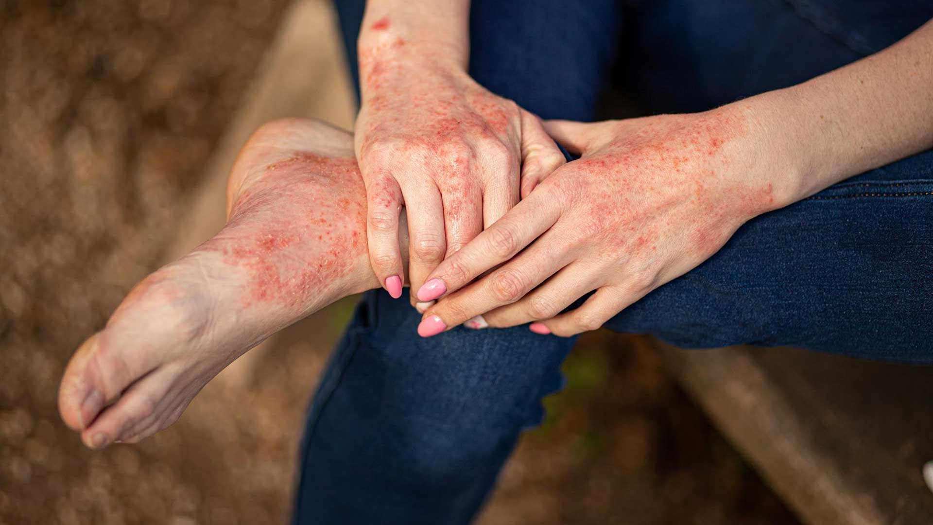 Eczema