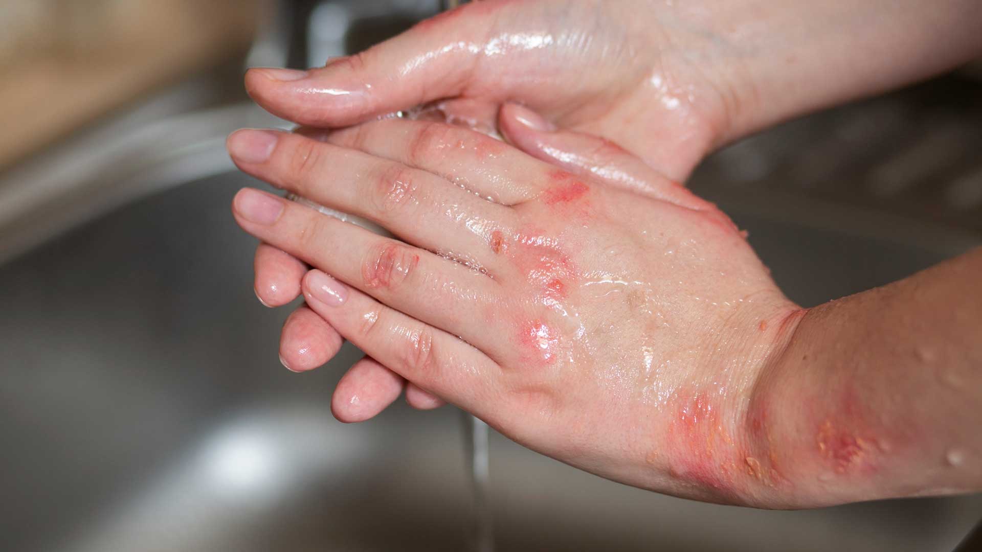 Obsessive Compulsive Disorder (OCD)