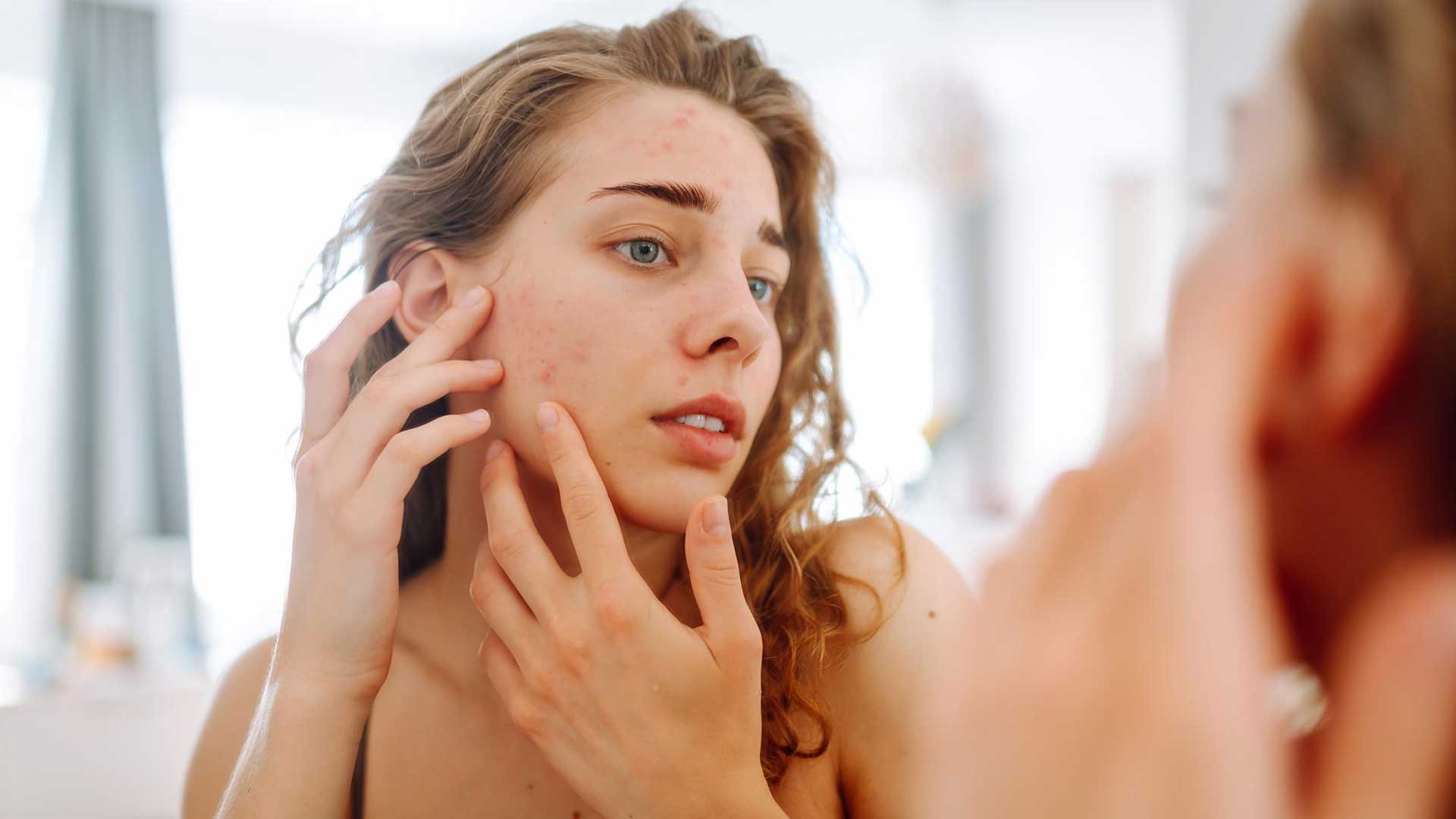 Skin Picking (Dermatillomania)