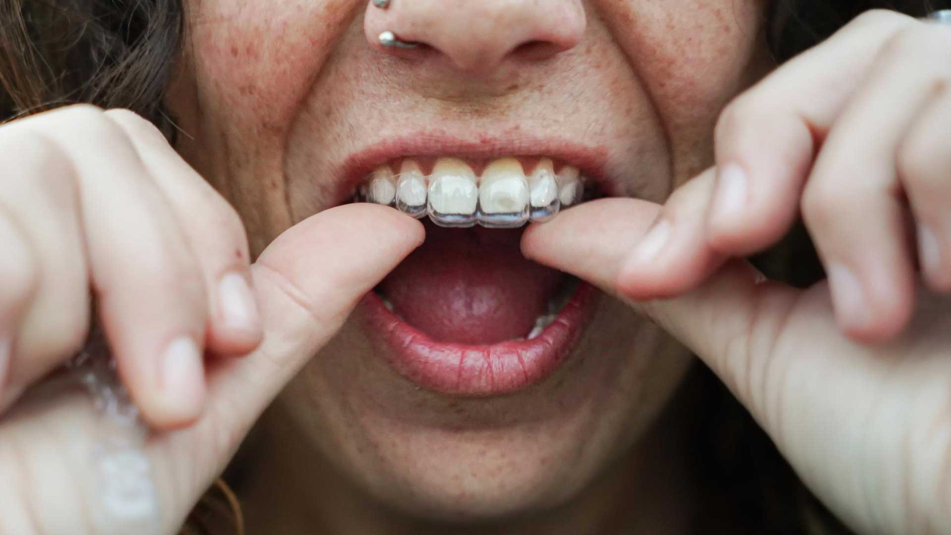 Teeth Grinding (Bruxism)